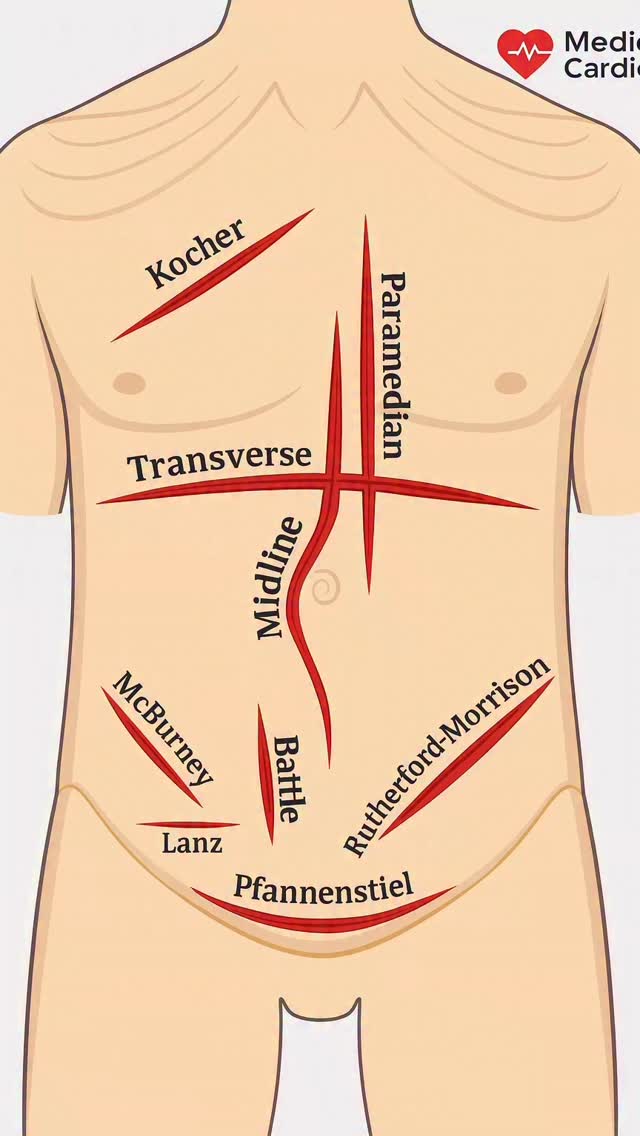 A quick overview of the most commonly used abdominal surgical incisions ...