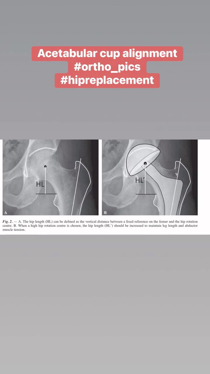 Acetabular cup alignment THR #orthopics Follow for more | Ortho-Pics ...