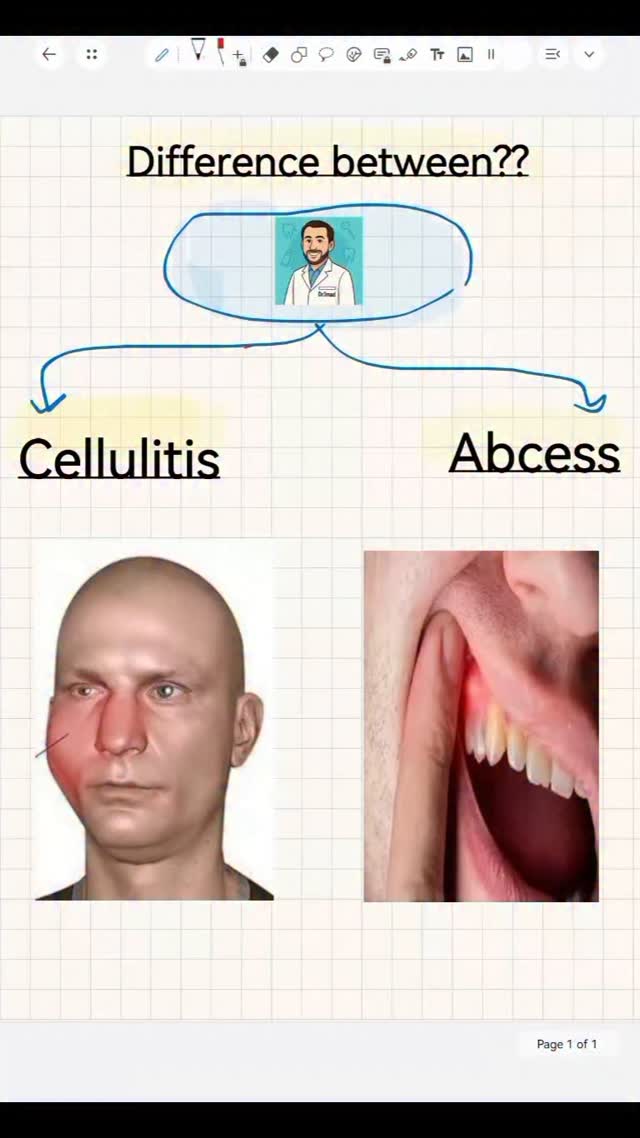 Difference between cellulitis and odontogenic abcess #dentalstudent # ...