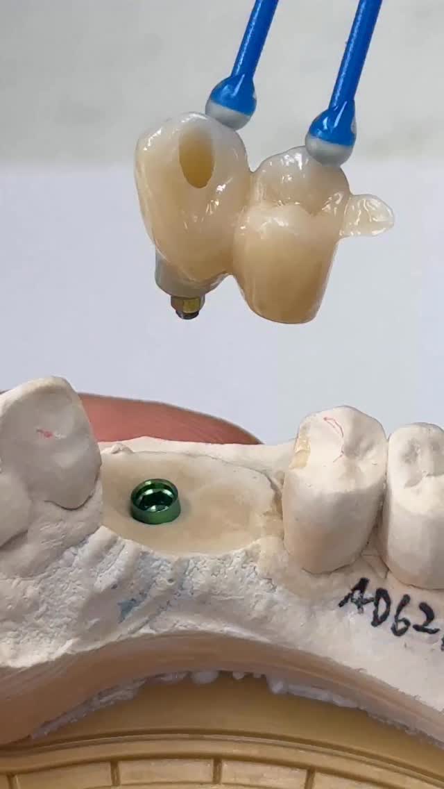 Custom mini syton hybrid implants with extra wing! | CEO Luke Kahng ...