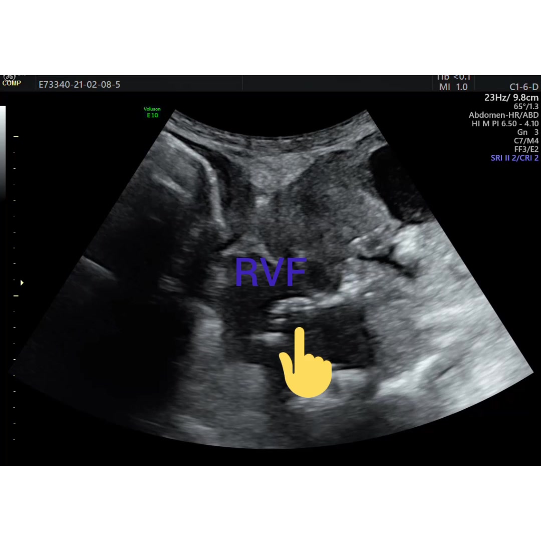 Rectovaginal Fistula Ultrasound