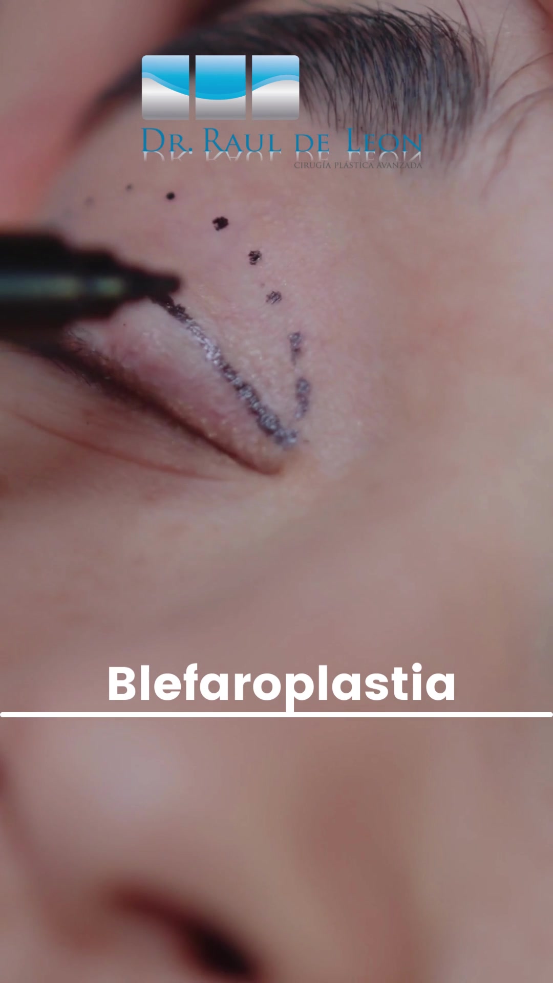 La blefaroplastia se realiza para reparar los párpados caídos , lo que ...