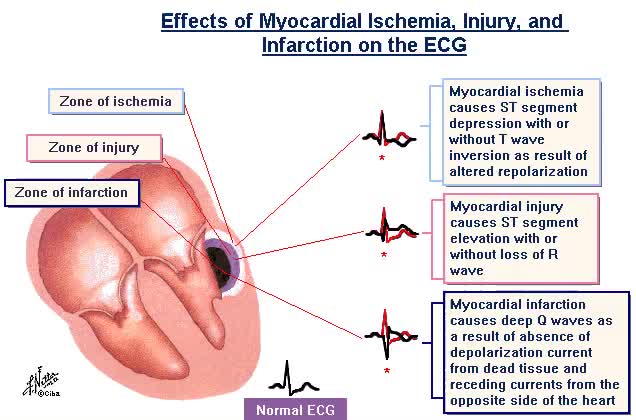 🔰 Effects of Myocardial ischemia, Injury & Infarction on the #EKG 🔗 ...