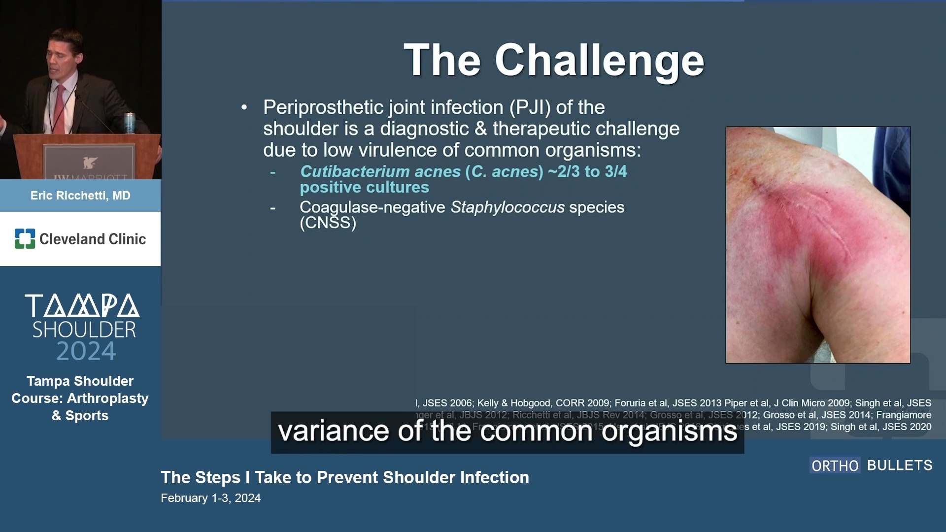 New expert video by Eric Ricchetti, MD of Cleveland Clinic at the 2024 ...