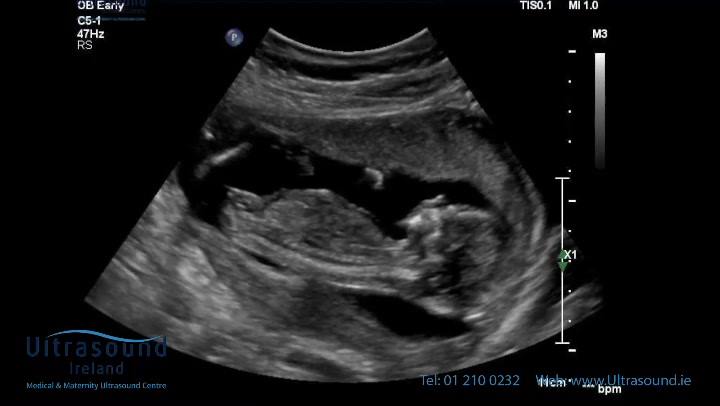 Scan of the Week: this video clip of a sweet 15 week old baby during ...