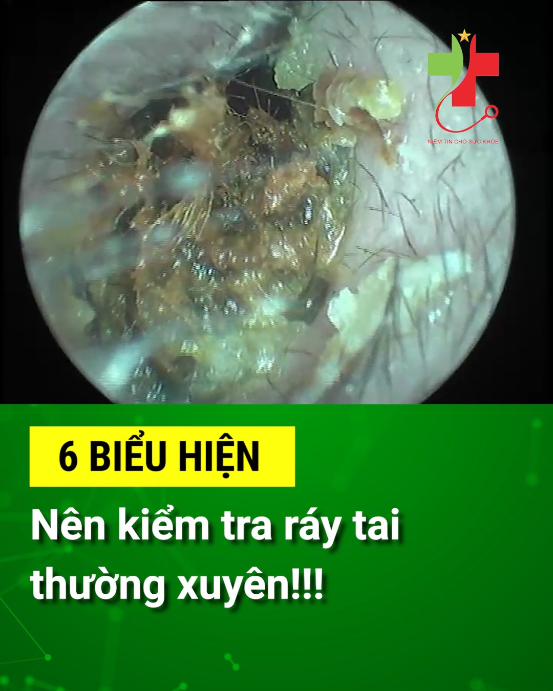 Nút ráy tai siêu to khổng lồ 👂 | 👂👂 NÚT RÁY TAI - những điều bên biết ...
