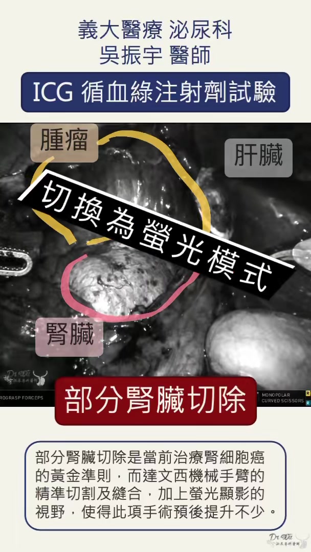 ICG test（循血綠測試） 原本是用在肝臟功能測試 後來發現他在遠紅外光下 可產生如外星人血液般的螢光綠顯影 藉此讓外科醫師確認血流的走向 ...