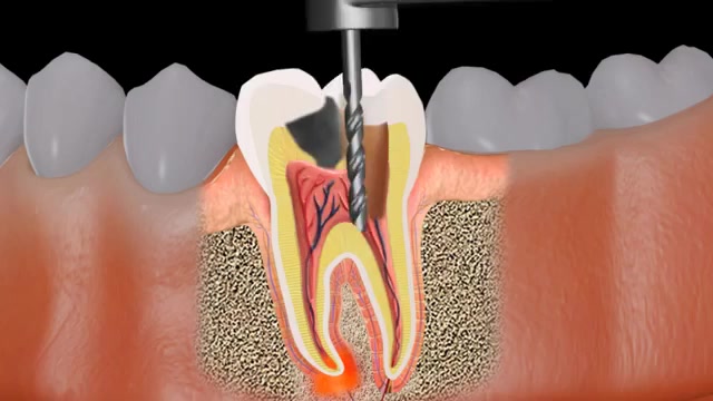 How is ROOT CANAL TREATMENT DONE ? ( RCT ) 👉The entire root canal ...
