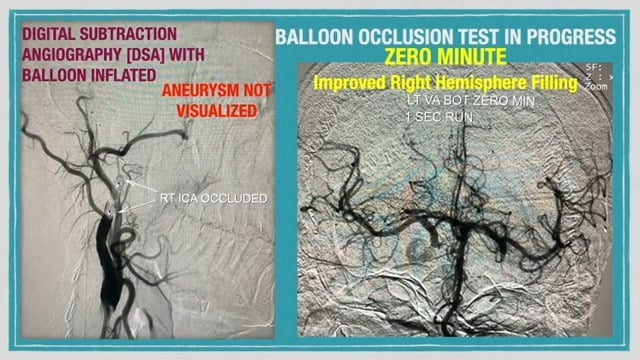 Balloon Occlusion Test followed by Carotid Occlusion, video by Dr ...