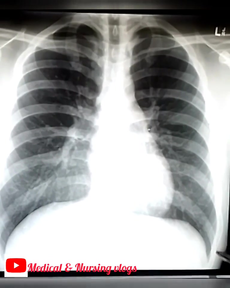 How to read chest X ray Easily ... For full video https://www.youtube ...