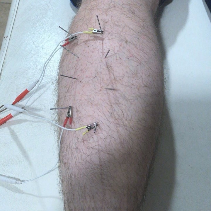Trigger-point dry needling is an invasive procedure where a fine needle ...