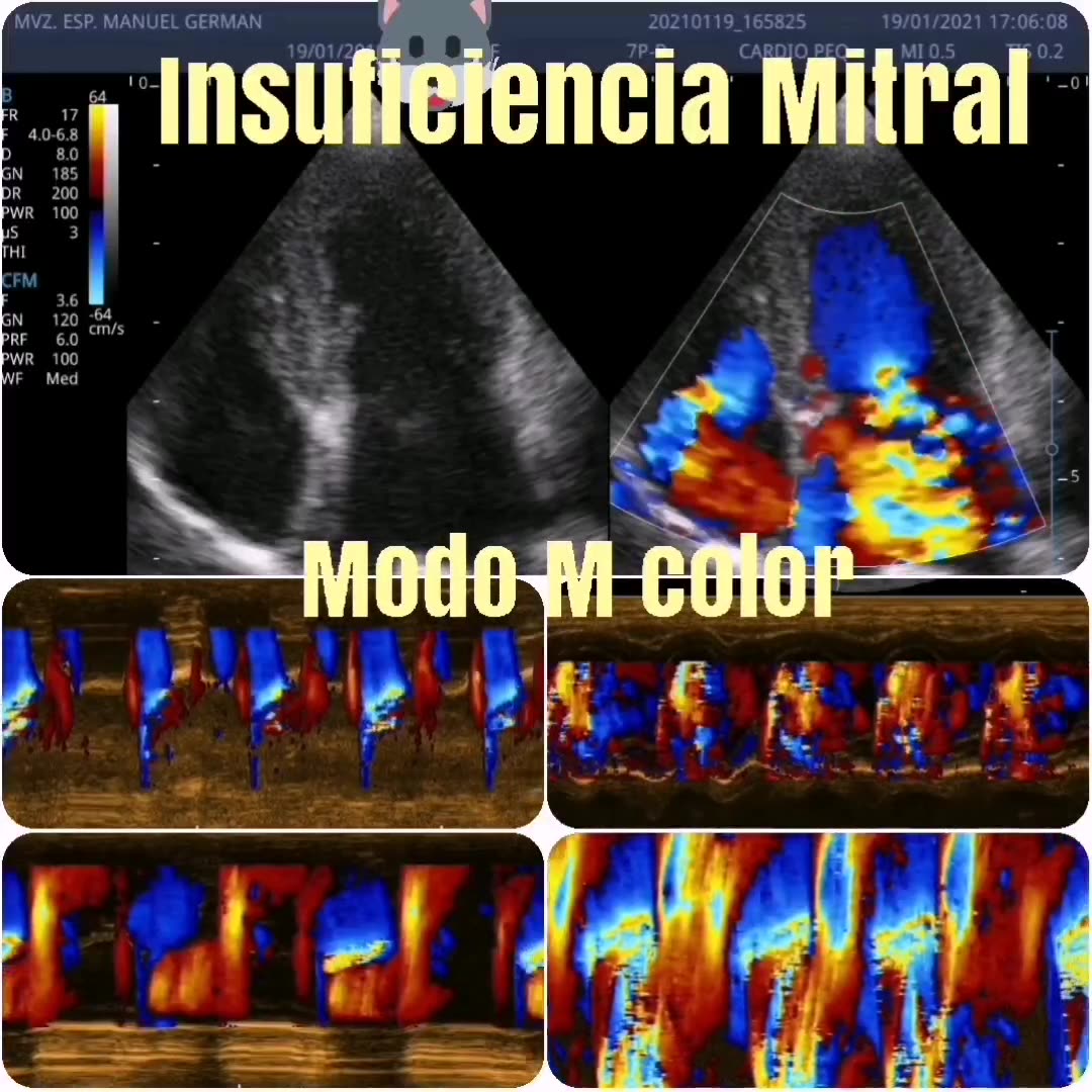 Evaluación del jet de regurgitación en EVD Mitral con modo M Color en ...