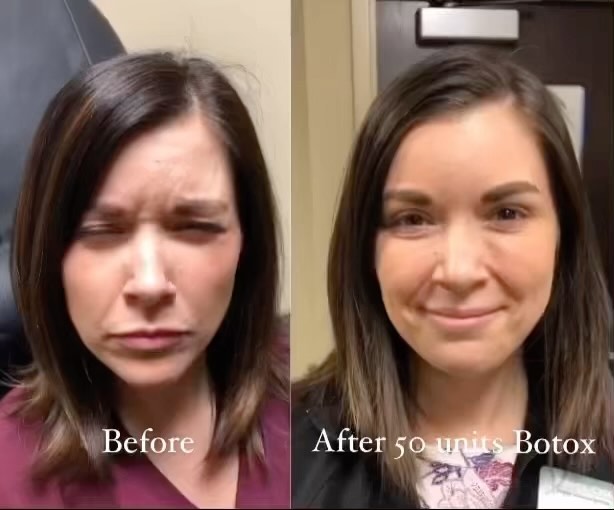 STOP 🛑 Cookie Cutter🍪 Botox! 💉 . . Botox is not a one size fits all ...