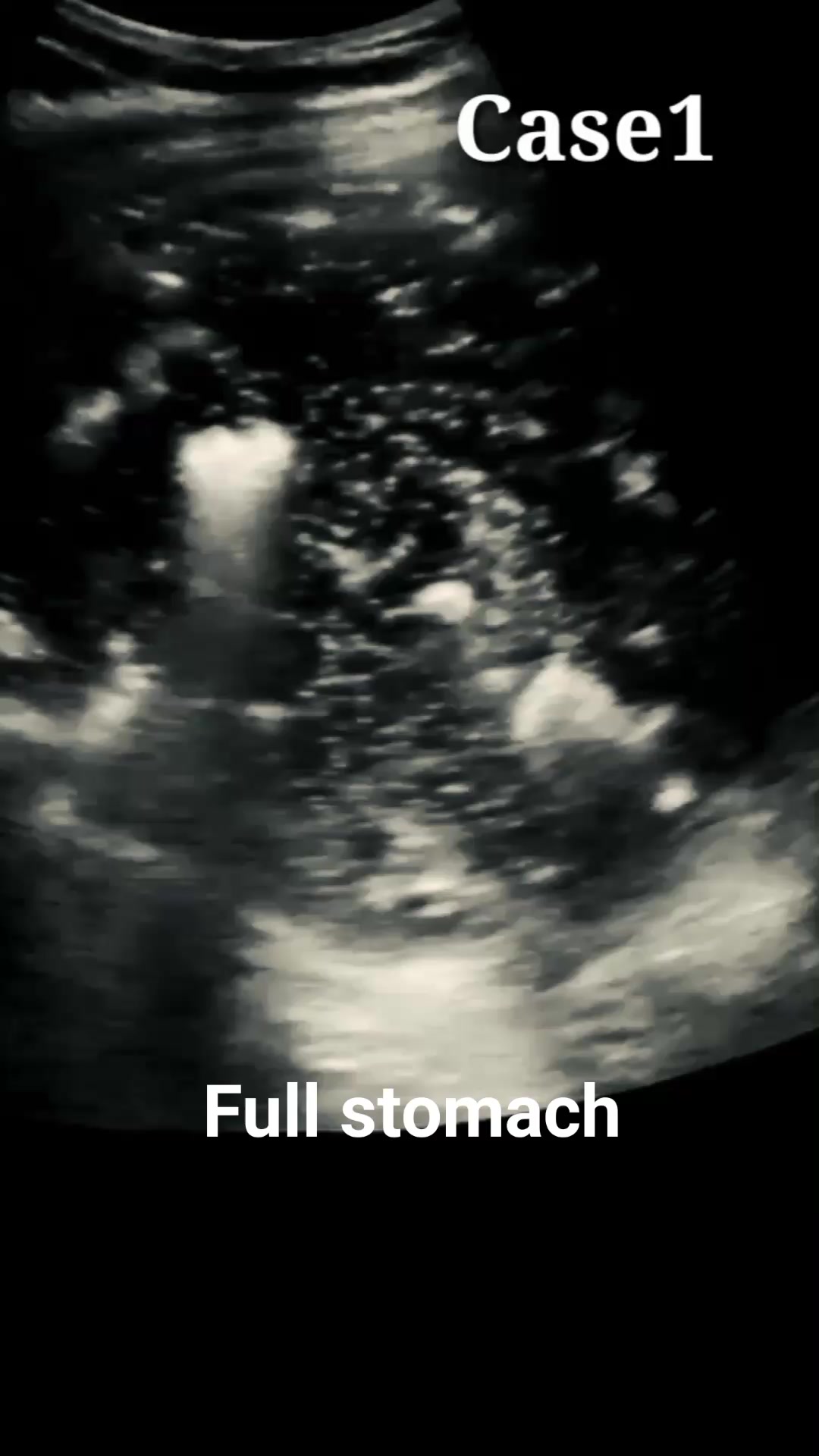 Left upper quadrant FAST view. A large rounded fluid filled structure ...