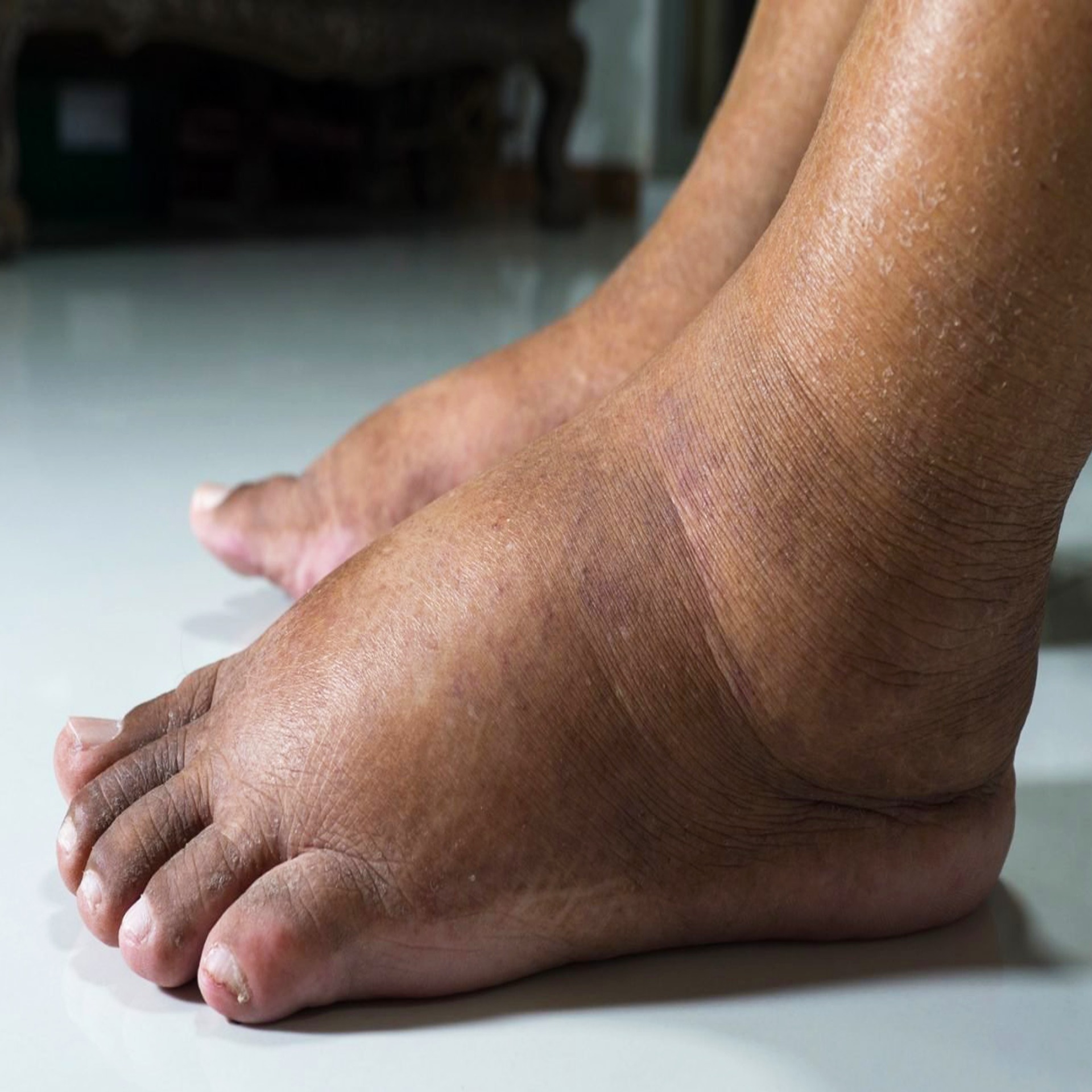 Sofre com PÉS INCHADOS? Minha Avó Eliminou a Má Circulação e os Pés ...