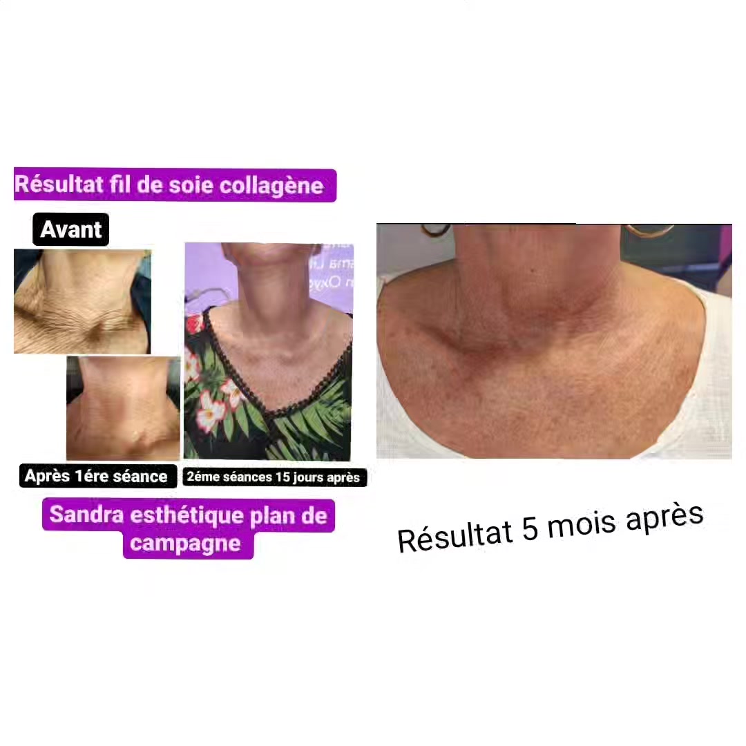 Fils De Soie Collagène Avant Après