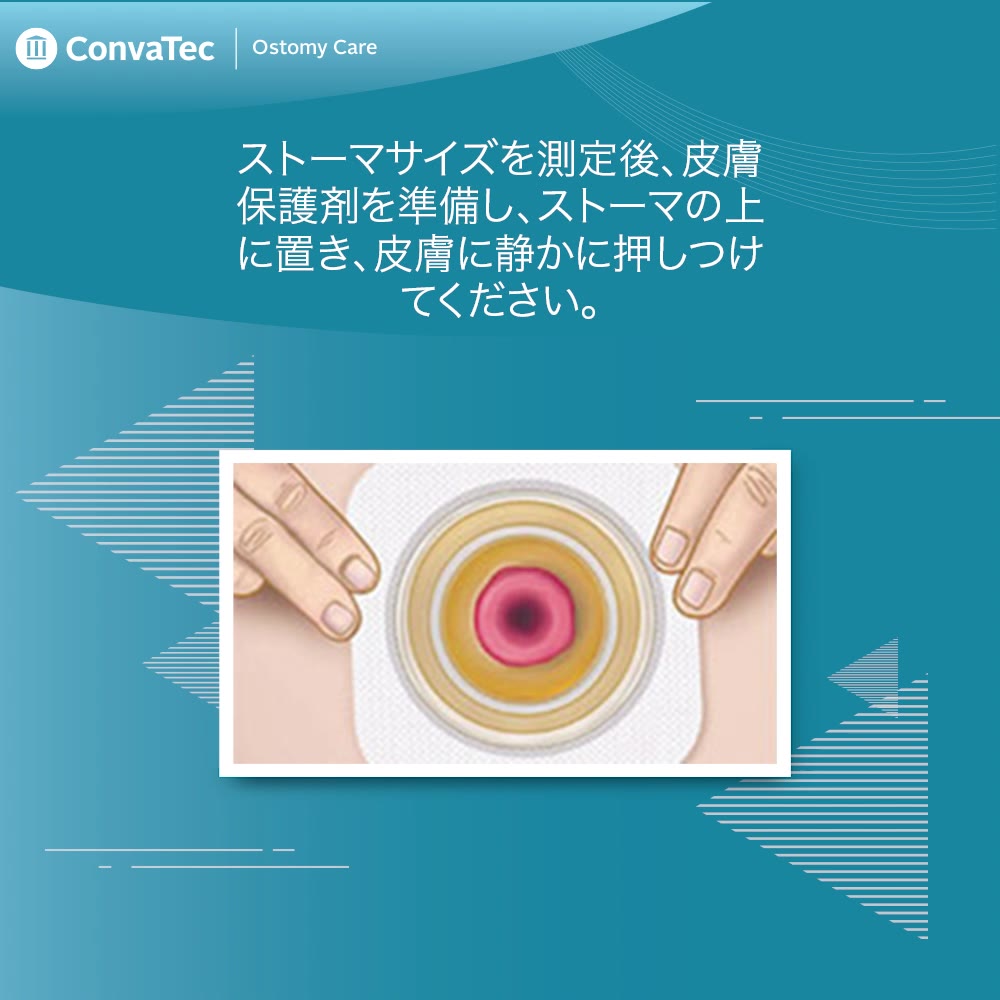 ストーマ装具を貼付する際には、貼付方法の手順を認識する必要が