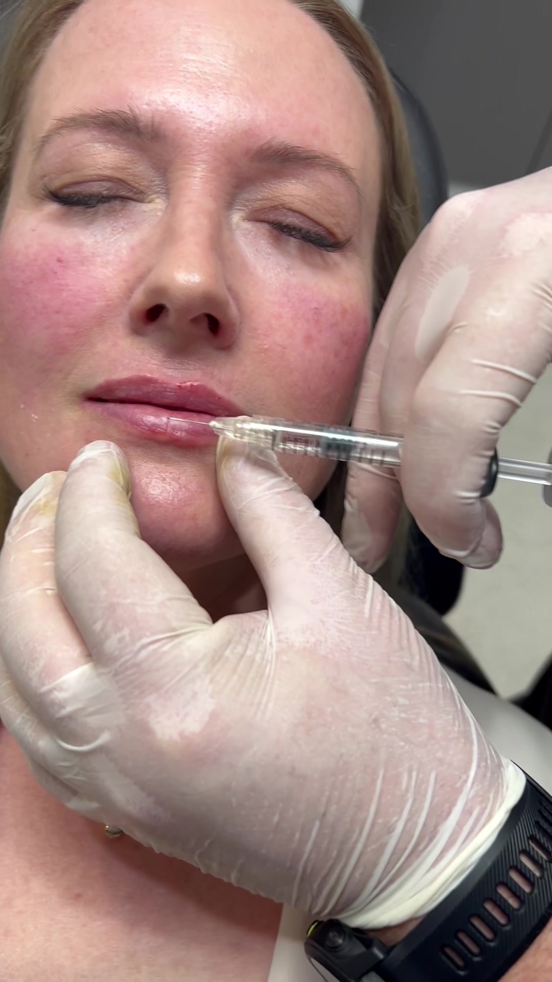 klow injection pain How to Inject for Achilles Injury klow peptide injection pain Mitigating