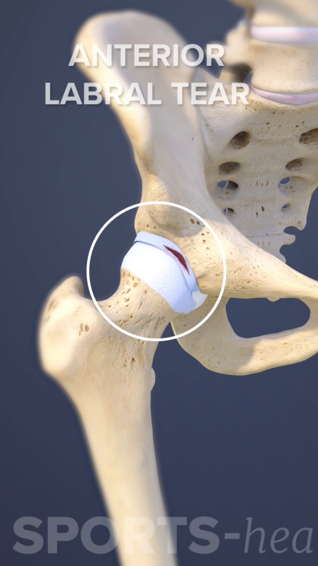 bpc 157 slap tear Persistent shoulder pain and popping after rotator cuff and labrum injury Peptides for Gut Health 1-bottle Format:10ml