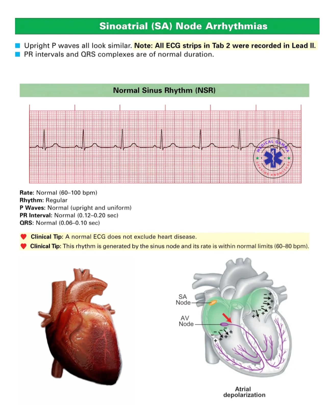 #Sinoatrial (SA) node #arrhythmias, also known as sinus node ...