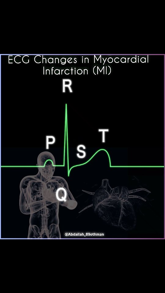 🫀MI ECG Timeline: Acute ST elevation (hrs), pathological Q waves (12h ...