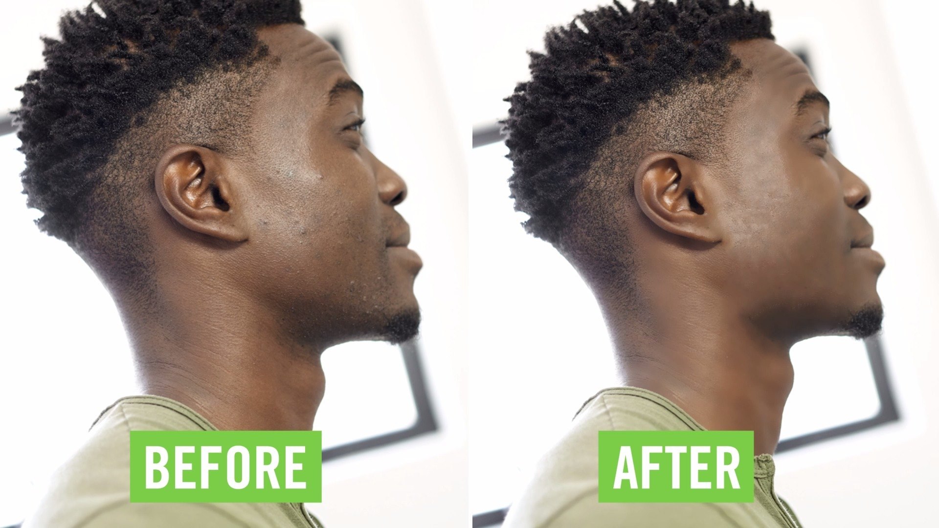 Treat razor bumps, ingrown hairs and shaving rash with DX Smooth Bump ...