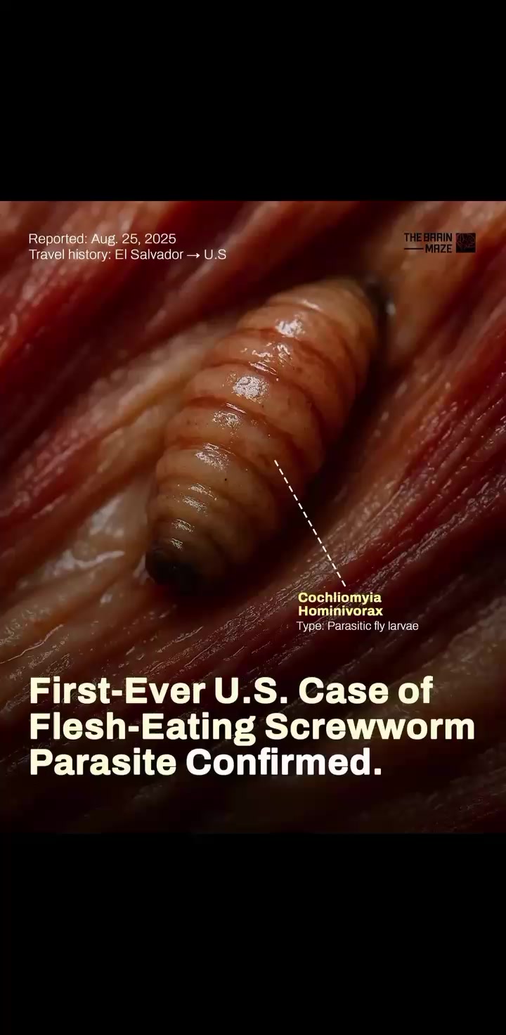The United States has confirmed its first-ever human case of the flesh ...