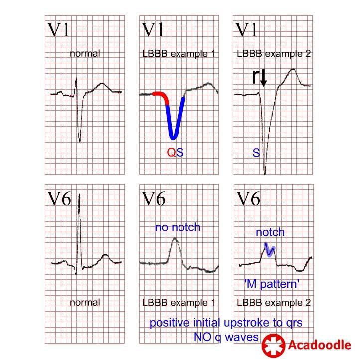 ECG Diagnosis of Left Bundle Branch Block - Some quick tips | ECG ...