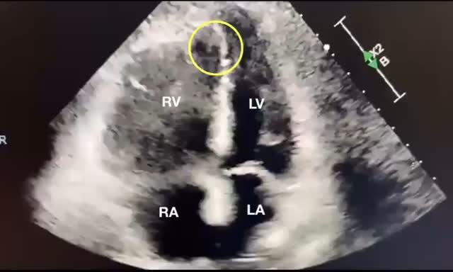 McConnell’s sign is an echocardiographic finding classically described ...