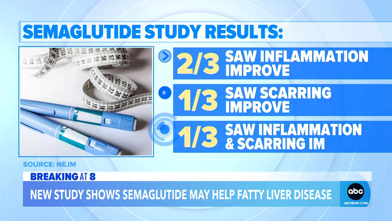 New study finds weight loss drugs may help treat fatty liver disease | GMAhttps://www.goodmorningamerica.com/wellness/video/new-study-finds-weight-loss-drugs-treat-fatty-121348535 | Dr. Tara Narula
