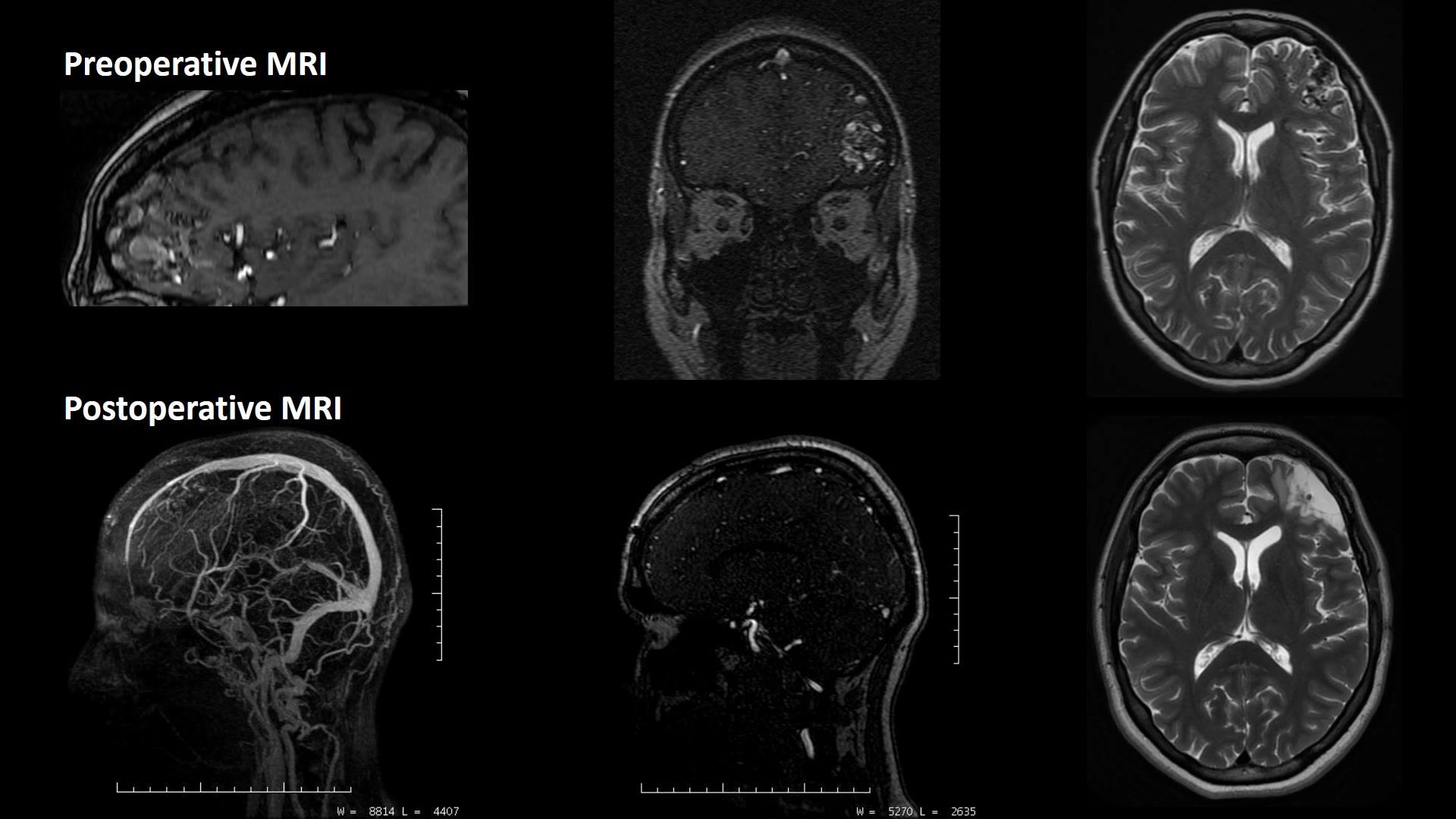High resolution, postoperative MR Imaging and dynamic Angiography (MRI ...