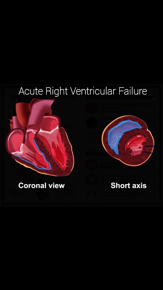 Acute Right Ventricular Failure: Pathophysiology, Aetiology, Assessment ...