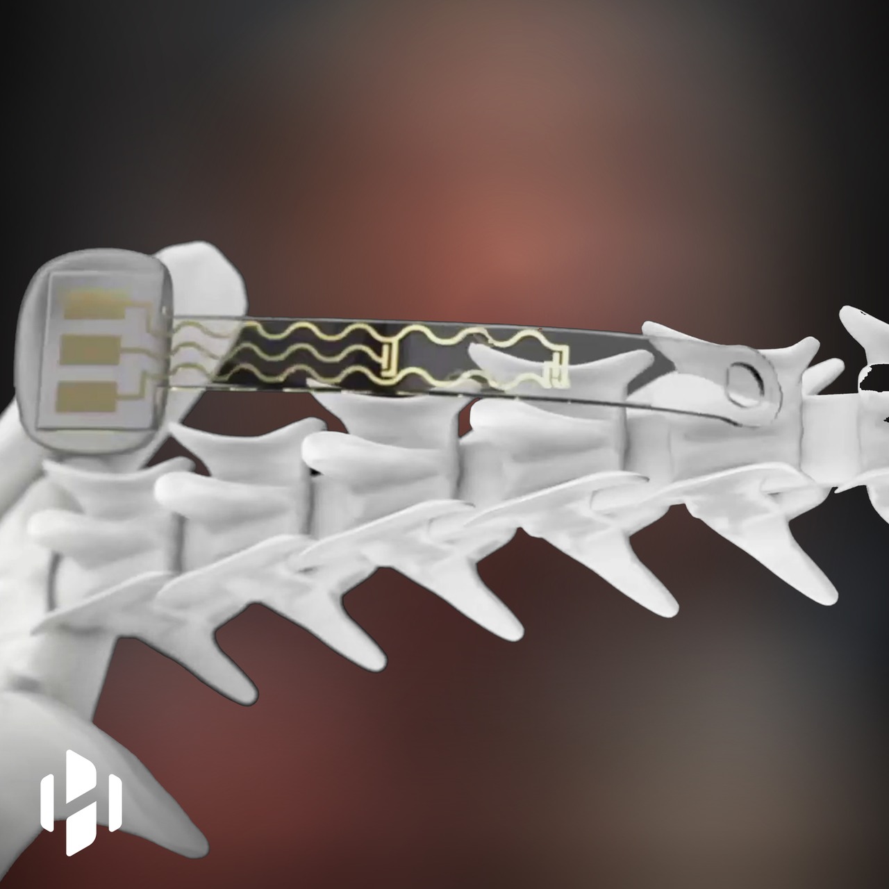 Spinal implant allows a paralyzed man to walk again. | Hashem Al-Ghaili ...