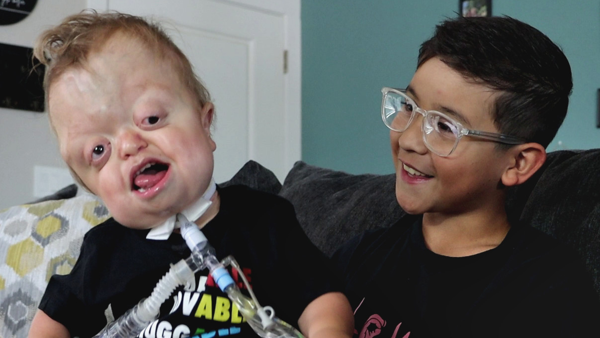 Raedyn lives with a facial difference that is caused by Pfeiffer ...