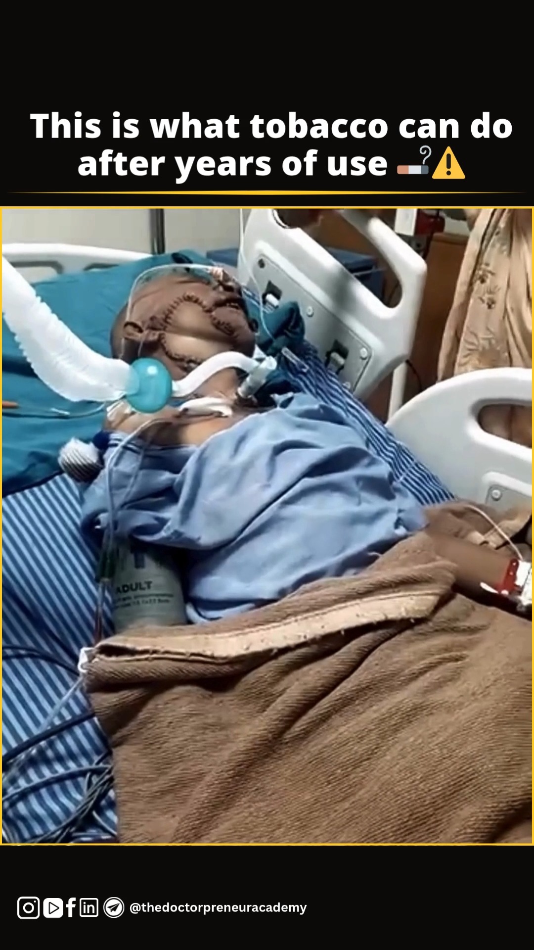 This is what tobacco can do after years of use 🚬⚠️, long-term addiction  can seriously harm your health., #tobaccodangers #quitnow #smokingkills  #healthwarning #saynototobacco #addictionawareness 