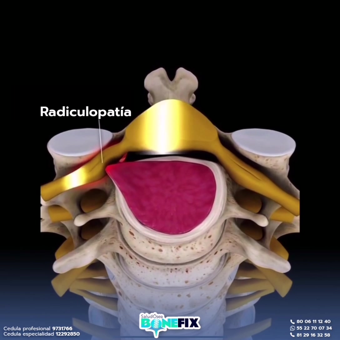 La radiculopatia cervical corresponde al dolor del cuello que se ...