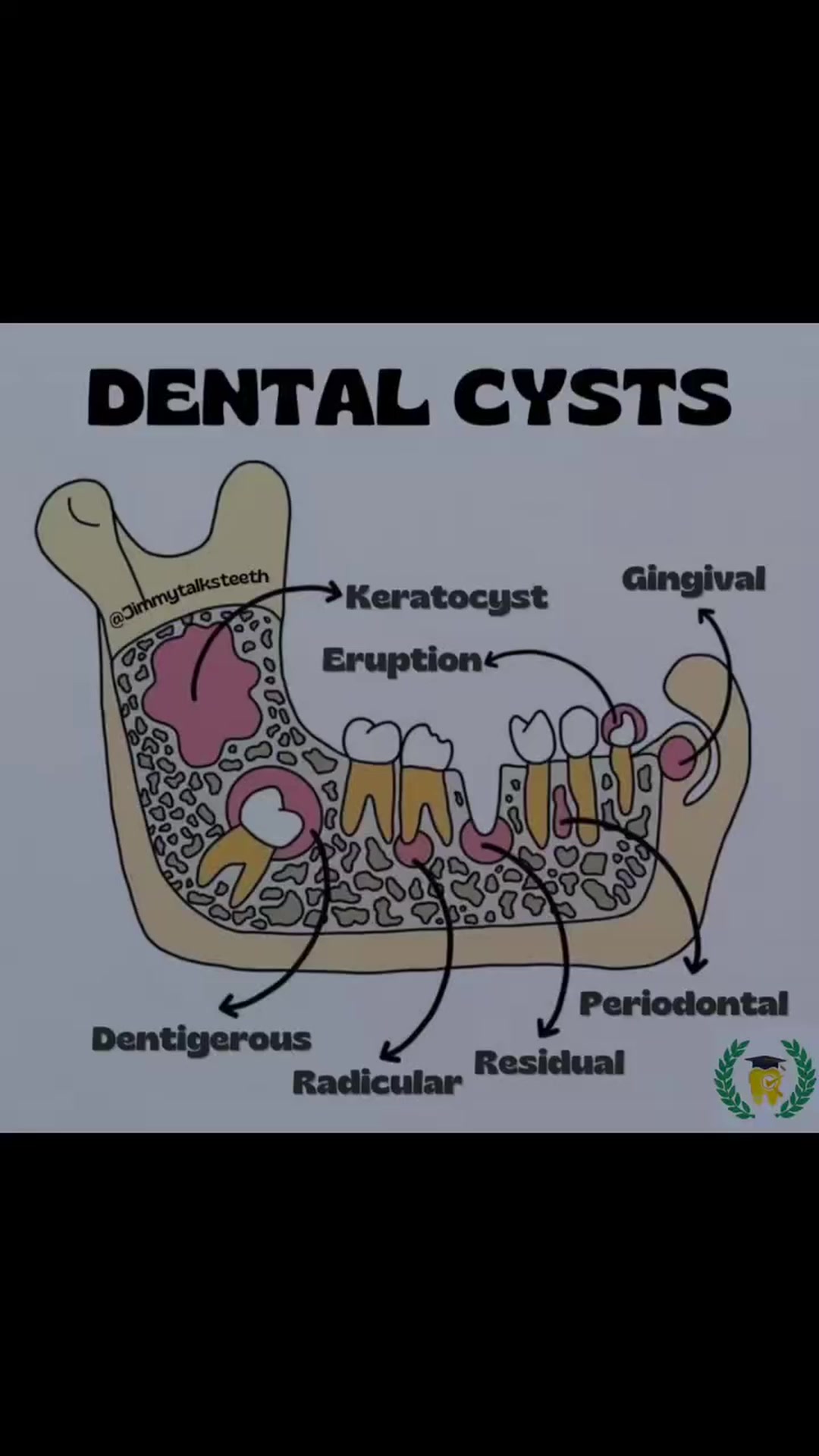 Types of Dental Cysts Dental cysts are fluid-filled sacs that can form ...