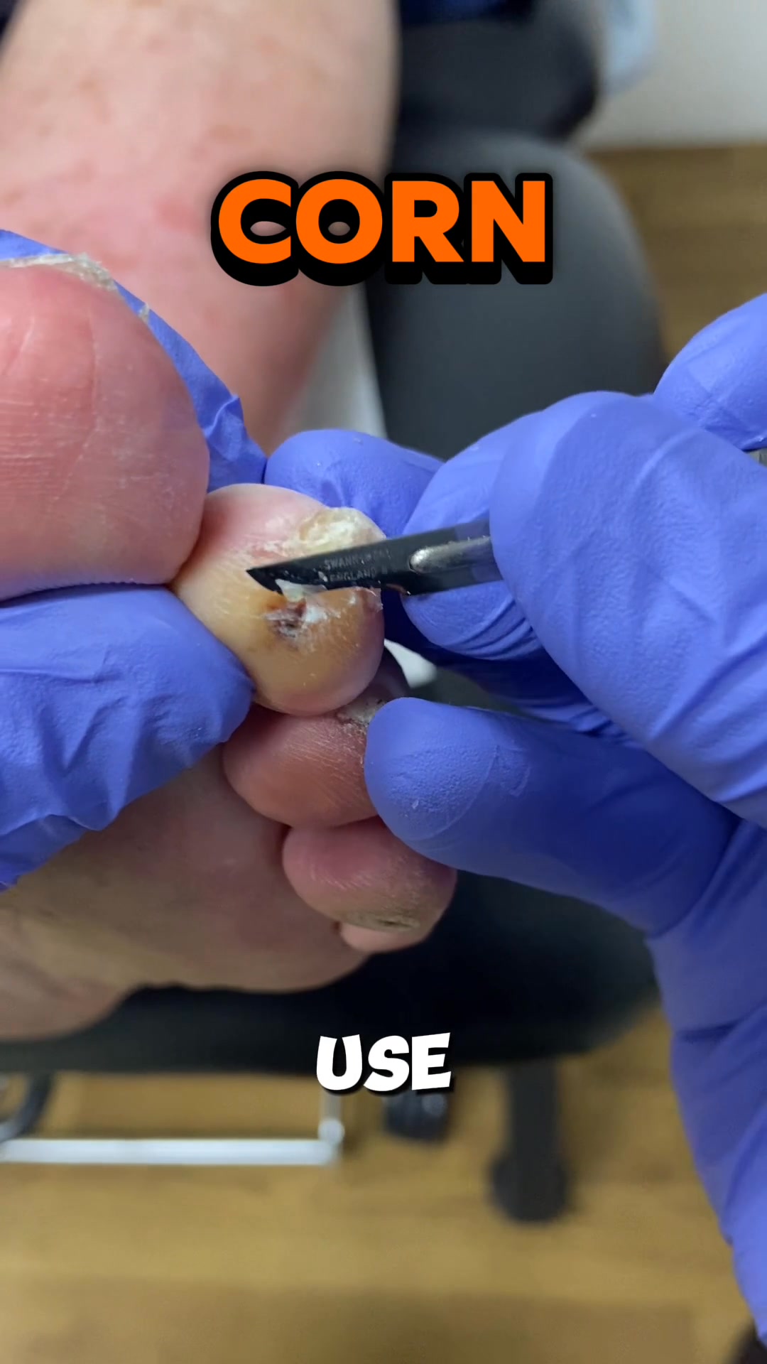 Removing a painful corn from the apex of the second toe today. You can ...