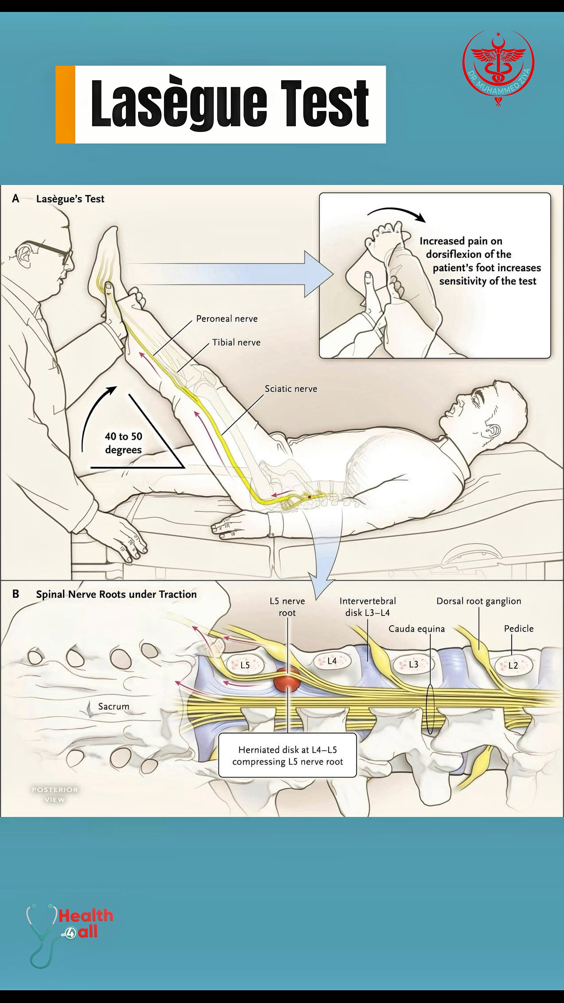 the-lasegue-test-or-straight-leg-raise-slr-test-is-a-physical