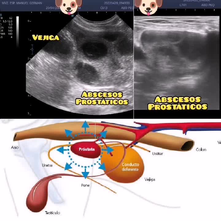 PROSTATITIS SÉPTICA evidenciando múltiples ABSCESOS en todo el ...