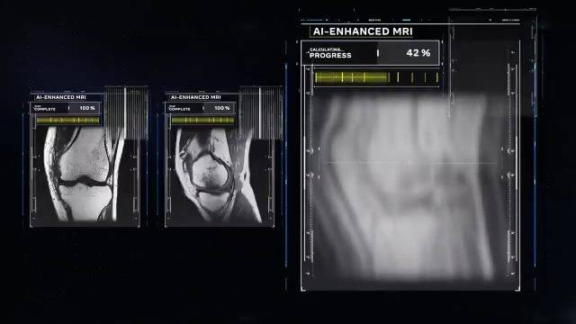 FastMRI breakthrough shows AI-accelerated MRIs interchangeable with ...