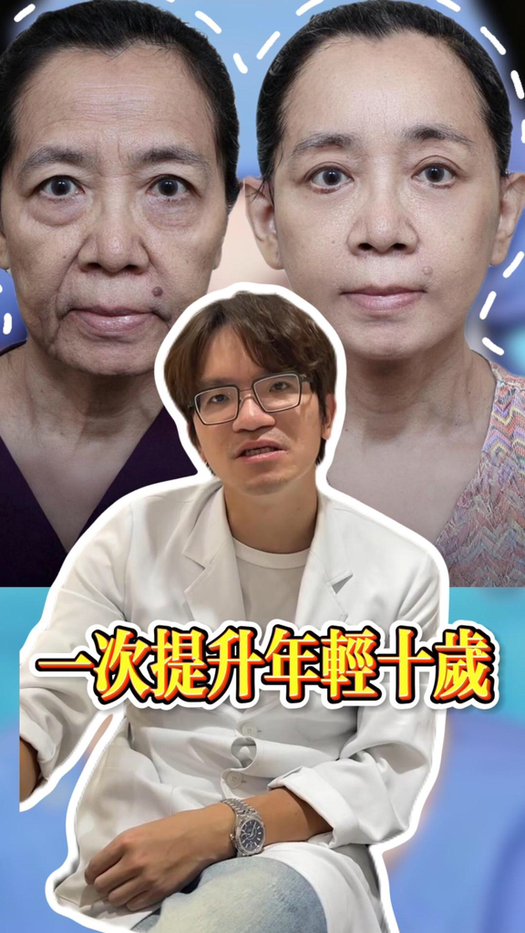 無痕全臉抗衰，一次提升年輕十歲 #臺北 #高雄 #臺中 #筋膜提升 #無痕筋膜提拉 #醫美 #保養 #逆齡抗衰 #面部年輕化 ...