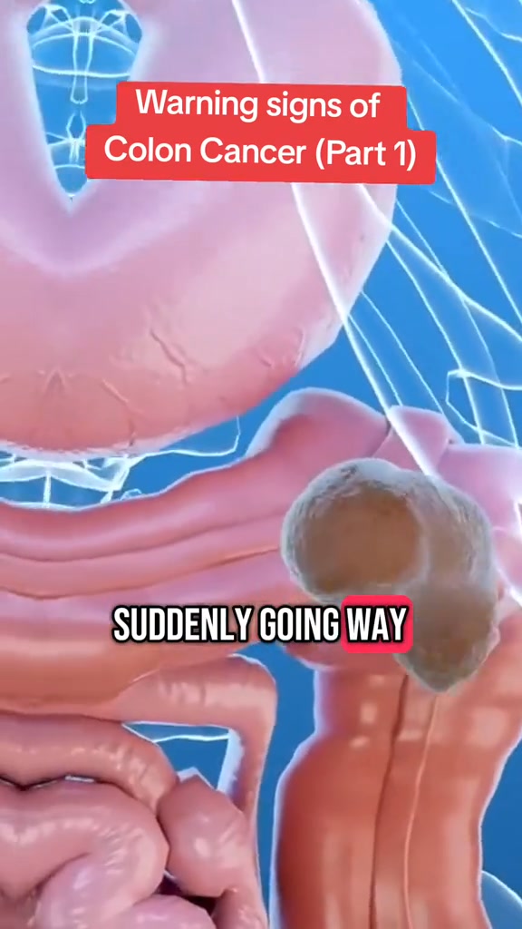 Warning Signs of Colon Cancer #coloncancerawareness , #cancersymptoms ...