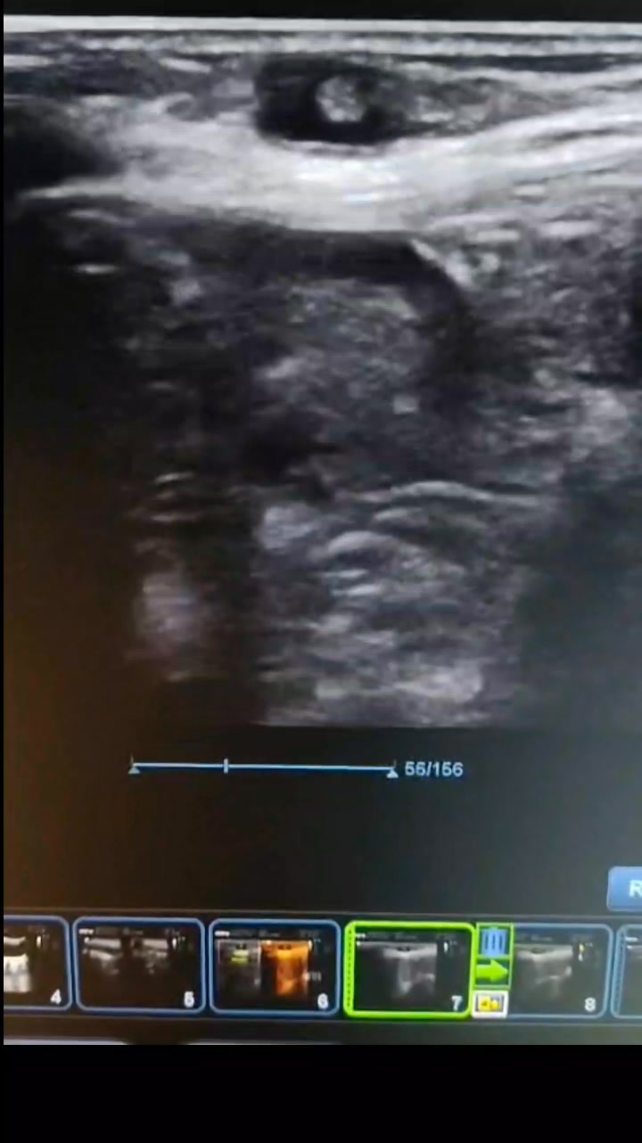 Right iliac fossa area of scan | Sonographer Ultrasound | Facebook