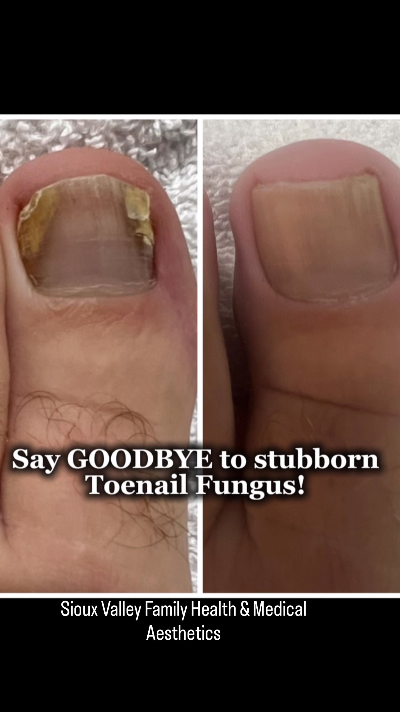 Clear Nails Are Possible with Alma Harmony 2.0! FDA-cleared laser ...