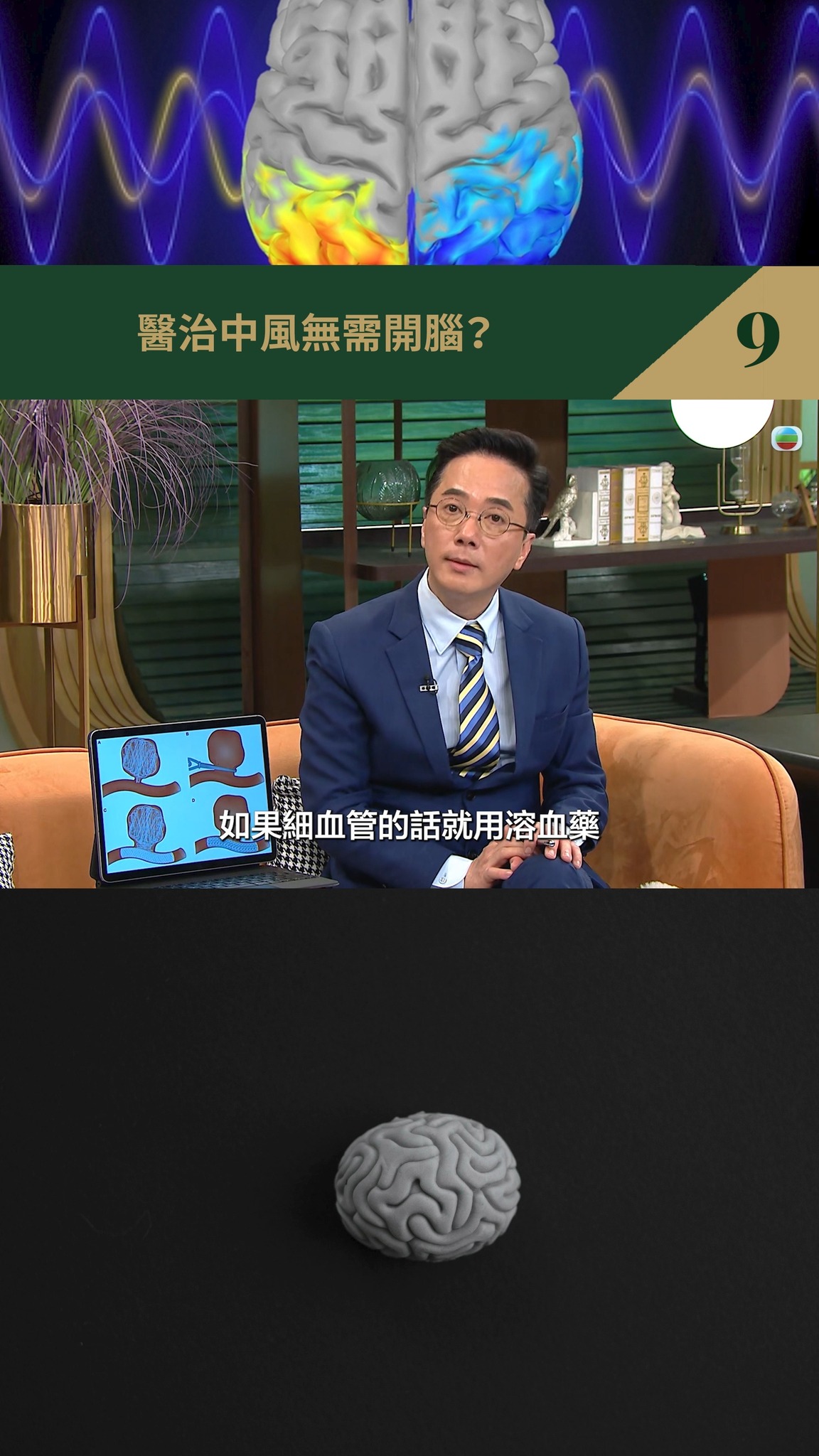 醫治中風無需開腦？(9) #中風 #腦中風 #面歪 #暈眩 #高血壓 #手腳痲痺 #手腳無力 #行路不穩 #中風風險評估 #MRI #磁力共振 ...