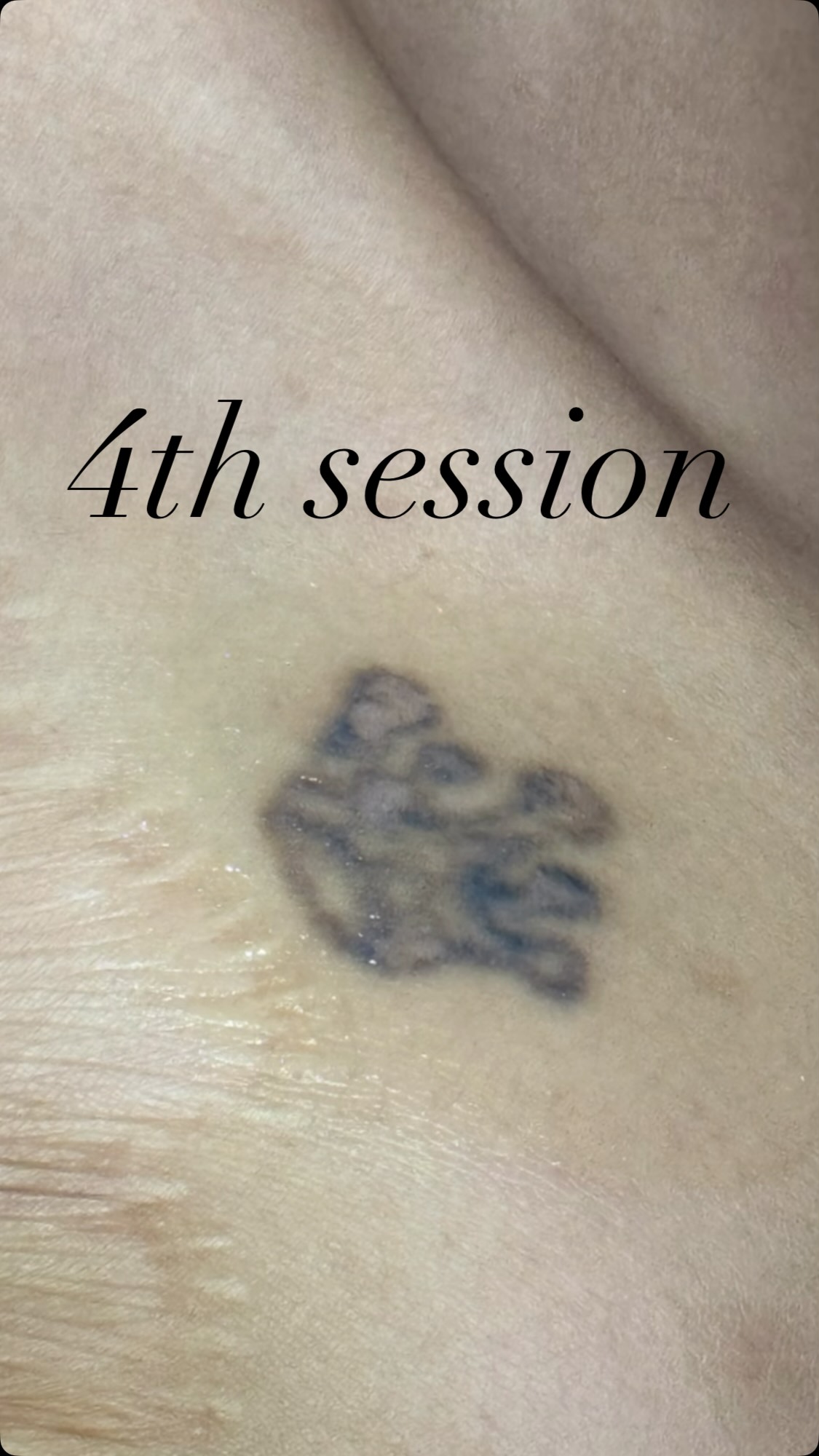 Tattoo Removal | 4th Session Update ️ Noticeable fading of pigment ️ ...