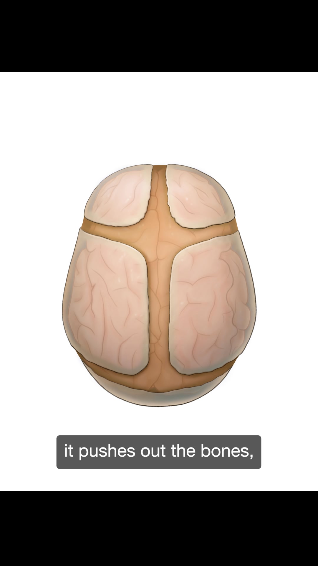 Craniosynostosis is a condition where a baby's skull bones fuse