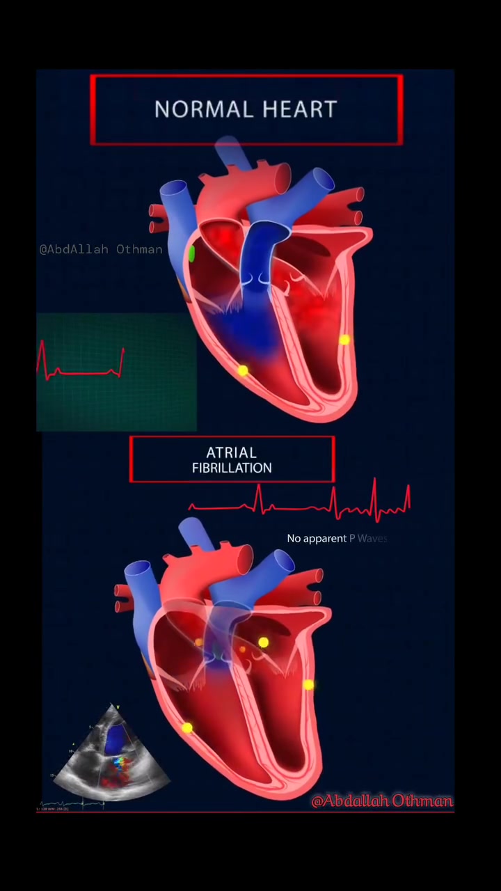Atrial Fibrillation (AFib) vs. Normal Rhythm: A Visual Guide Normal ...