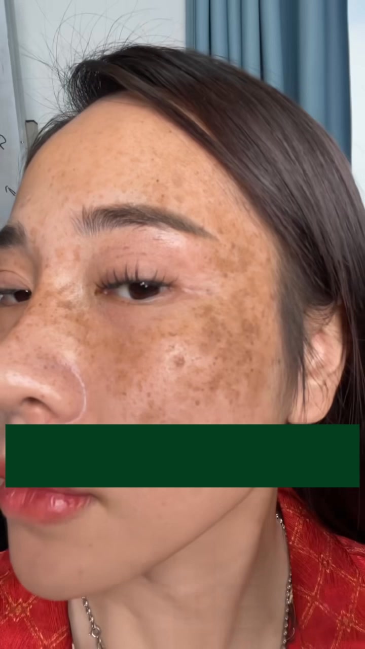 bilis beauty glutathione melasma serum – Freckles – Rough, Sagging Skin? Don't worry — here's your skin savior: the Combo ✨ Brightening Toner: Instantly hydrates and balances skin pH, prepping your ski which crystallizes when exposed Bpc-157 & Tb-500 Recovery skin_type|combination Package:Single Pack
